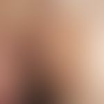 Erythrasma: solitärer, chronisch dynamischer, seit 8 Wochen kontinuierlich wachsender, großflächi...