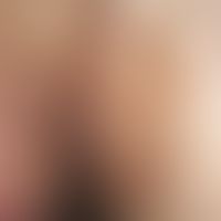 Erythrasma:solitary, chronically dynamic, continuously growing for 8 weeks, large-area, blurred, ...