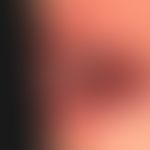 Papillomatosis floride orale: pronounced, large-area, wart-like proliferation of the buccal mucos...