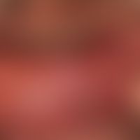 Verrucae vulgares: linearly arranged, broad-based, white-grey, symptomatic papules (Remark: in a ...