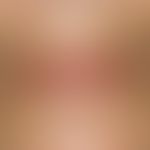 Lentigo simplex: multiple, sharply defined, light-brown pigmentation spots on light-exposed areas...