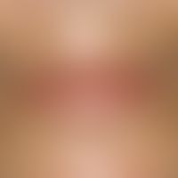 Lentigo simplex: multiple, sharply defined, light-brown pigmentation spots on light-exposed areas...