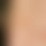 Lentigo simplex: sharply defined, light brown pigmented spot on a light exposed area on the bridg...