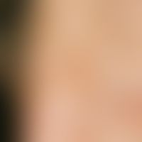 Lentigo simplex: sharply defined, light brown pigmented spot on a light exposed area on the bridg...