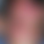 Schwerer Zoster ophthalmicus. Seit&nbsp;5 Tagen zunehmende, rechtsseitige Kopfschmerzen mit begle...
