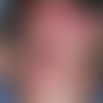Zoster opthalmicus: flächenhaftes, linksseitiges (hier durch markierte Mittellinie angezeigt) Öde...
