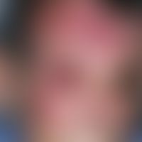 Zoster opthalmicus: flächenhaftes, linksseitiges (hier durch markierte Mittellinie angezeigt) Öde...