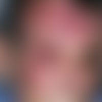 Zoster. Seit&nbsp;5 Tagen zunehmende, rechtsseitige Kopfschmerzen mit begleitendem Krankheitsgefü...