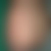 Varicella: generalized exanthema on the trunk and buttocks; characteristic polymorphic exanthema ...