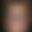 Röteln. Sehr diskretes, nicht juckendes, makulopapulöses Exanthem mit Beginn im Gesicht und Ausbr...