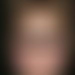 rubella. very discrete, not itchy, maculopapular exanthema with beginning in the face and spreadi...