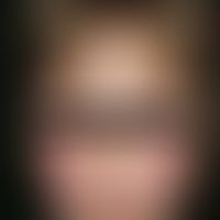 rubella. very discrete, not itchy, maculopapular exanthema with beginning in the face and spreadi...
