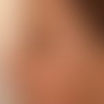Skin normal: normal smooth baby skin without any actinic changes.
