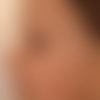 Skin normal: normal smooth baby skin without any actinic changes.
