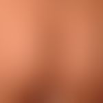 Skin normal: normal skin of the buttocks, clearly protruding structure of the vellus hair follicl...