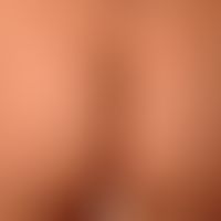 Skin normal: normal skin of the buttocks, clearly protruding structure of the vellus hair follicl...