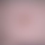 Keratosis seborrhoeic: Detailed picture of a new formation existing for about 1 year; occasional ...