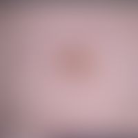 Keratosis seborrhoeic: Detailed picture of a new formation existing for about 1 year; occasional ...