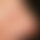 Kaposi's sarcoma. 37-year-old man infected with HIV has some circumscribed, symptomless, red plaq...