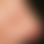 Kaposi's sarcoma. 37-year-old man infected with HIV has some circumscribed, symptomless, red plaq...