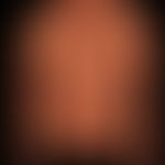 Kaposi's sarcoma epidemic:Disseminated patches and flat plaques, characterized by an arrangement ...