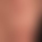 Kaposi's sarcoma epidemic:disseminated, bizarrely configured, spots and flat plaques, with a stri...