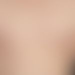 Kaposi sarcoma epidemic or HIV-induced: Disseminated flat reddish-brown, surface smooth, symptoml...