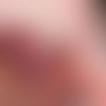 Kaposi's sarcoma epidemic: a bumpy tumour of the upper jaw that has been growing permanently for ...