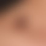 Naevus melanozytärer gewöhnlicher: seit frühester Kindheit bestehender melanozytärer Naevus.&nbsp...