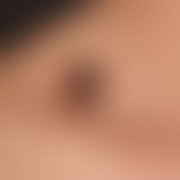 Nevus melanocytic common: melanocytic nevus existingsince earliest childhood. No symptoms. No gro...