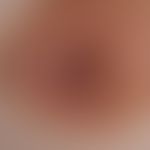 Naevus melanzytärer gewöhnlicher der Areola mamillae.
