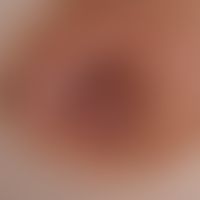 Nevus melanzytärer common of the Areola mamillae.
