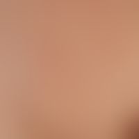 Nevus melnocytic halo Nevus breast_2.jpg