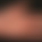 Naevus melanozytärer gewöhnlicher: multiple erworbene melanozytäre Naevi (Detailabbildung). &nbsp;

