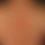 Basal cell carcinoma superficial: A slow-growing, symptom-free plaque with a central, weeping nod...
