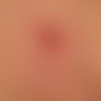 Basal cell carcinoma superficial: A slow-growing, symptom-free plaque with a central weeping nodu...