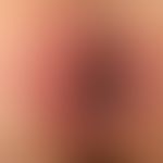 Condylomata lata. close-up. aggregated papules at the left border of the two-dimensional lesion w...