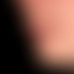 Cheilitis simplex (medicamentosa): chronische Lippenentzündung mit festhaftenden Schuppen, bei de...