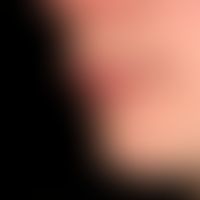Cheilitis simplex (medicamentosa): chronische Lippenentzündung mit festhaftenden Schuppen, bei de...