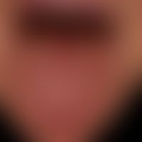 Glossitis rhombica mediana: extensive finding with cobblestone-like surface relief. known for sev...