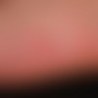Hand-foot-mouth disease: numerous, acute, painful, polygonal vesicles with a red courtyard; unspe...