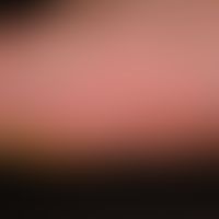 hand-foot-mouth disease: fresh and older painful blisters (and pustules) with a red courtyard tha...