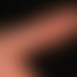 Hand-Fuß-Mund-Krankheit. Wenige, akute,&nbsp;schmerzhafte,&nbsp; polygonale Bläschen mit rotem Ho...