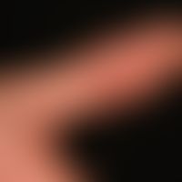 Hand-Fuß-Mund-Krankheit. Wenige, akute,&nbsp;schmerzhafte,&nbsp; polygonale Bläschen mit rotem Ho...