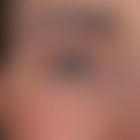 Hyalinosis cutis et mucosae: yellowish papules lined up like a string of pearls due to hyaline de...