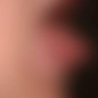 Hyalinosis cutis et mucosae: distinct macroglossia.
