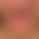 Lipoidproteinose (Hyalinosis cutis et mucosae):&nbsp;Zunehmende fleischige Makroglossie mit Verlu...