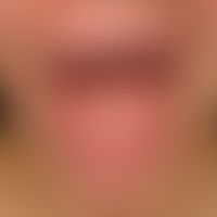 Hyalinosis cutis et mucosae. increasing fleshy macroglossia with loss of tongue mobility. paving ...