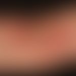 Lineare IgA-Dermatose: Ring-in Ringformationen als Ausdruck von schubhafter Aktvität.&nbsp;
