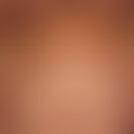 Lineare IgA-Dermatose mit symmetrischen urtikariellen Plaques und gruppierten Papulo-Vesikeln und...
